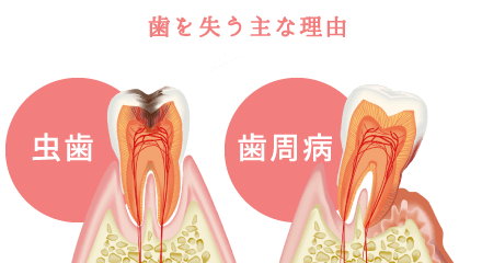 歯を失う主な理由「虫歯」「歯周病」