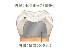 外側：セラミック（陶器）内側：金属（メタル）