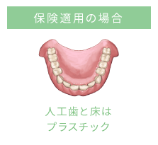 保険適用の場合 金属のクラスプ（留め具）