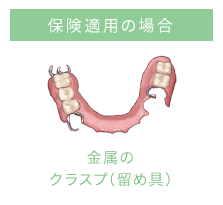 保険適用の場合 人工歯と床はプラスチック