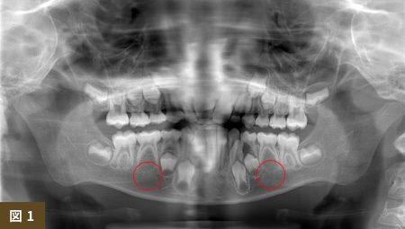 乳歯 レントゲン